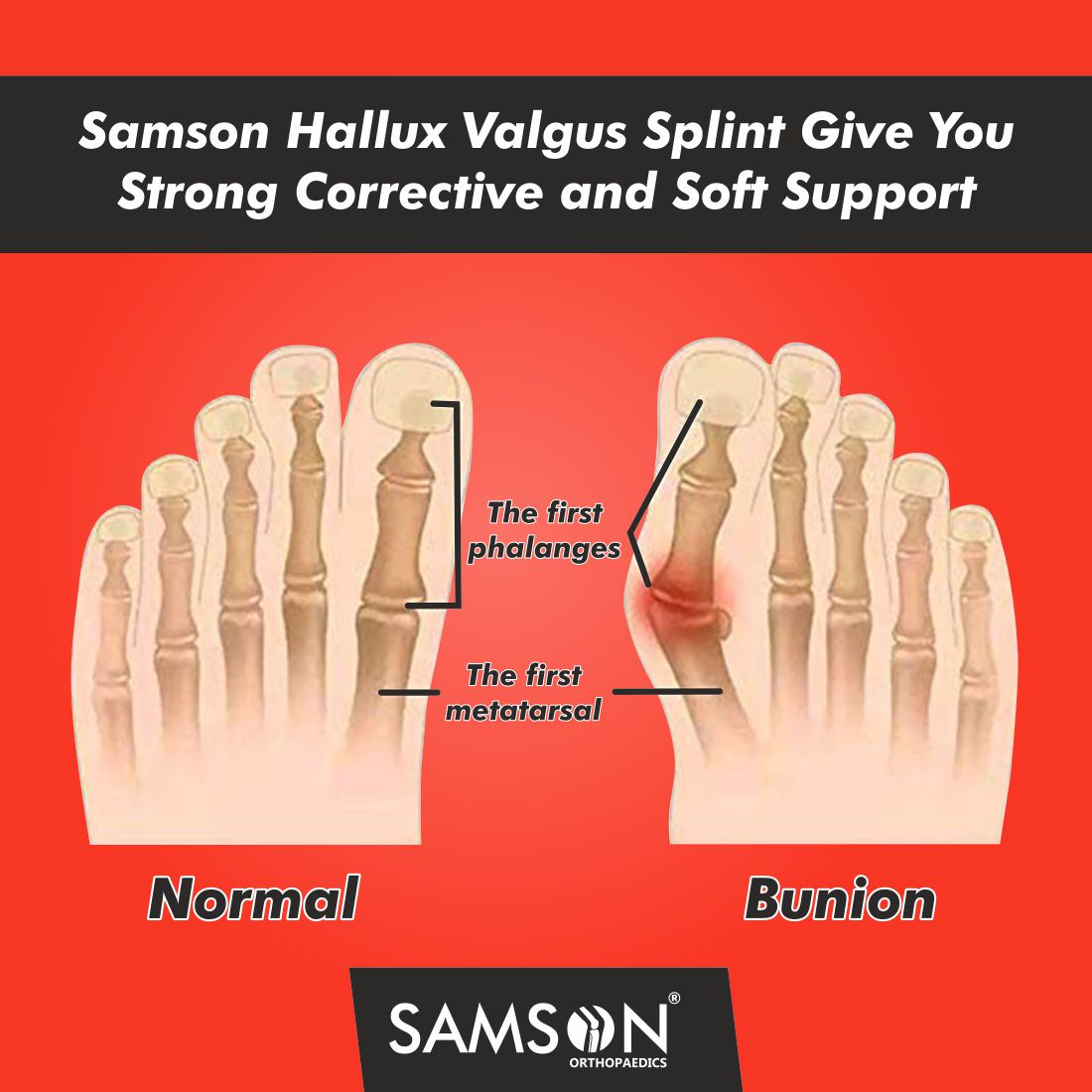 Samson Hallux Valgus Splint (Single)